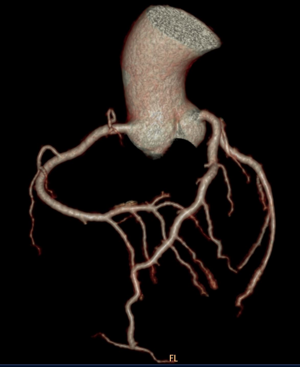 Herz-CT