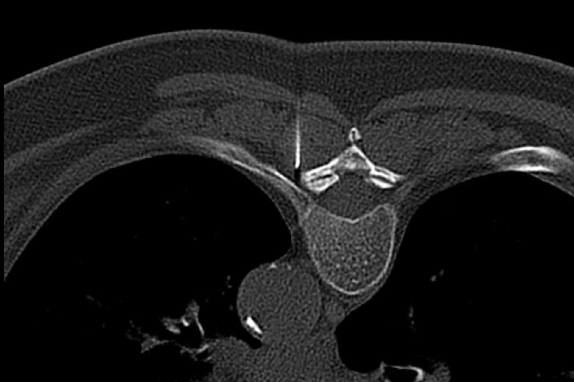 Nervenwurzelinfiltration